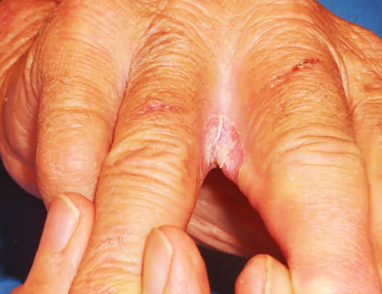 How Does Diabetic Skin Rash Look Like?