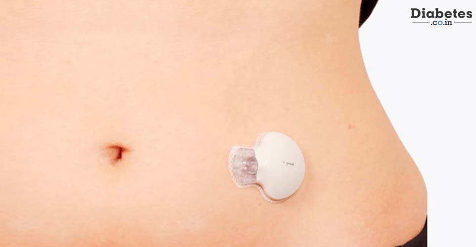 How Accurate is Continuous Glucose Monitoring (CGM)?