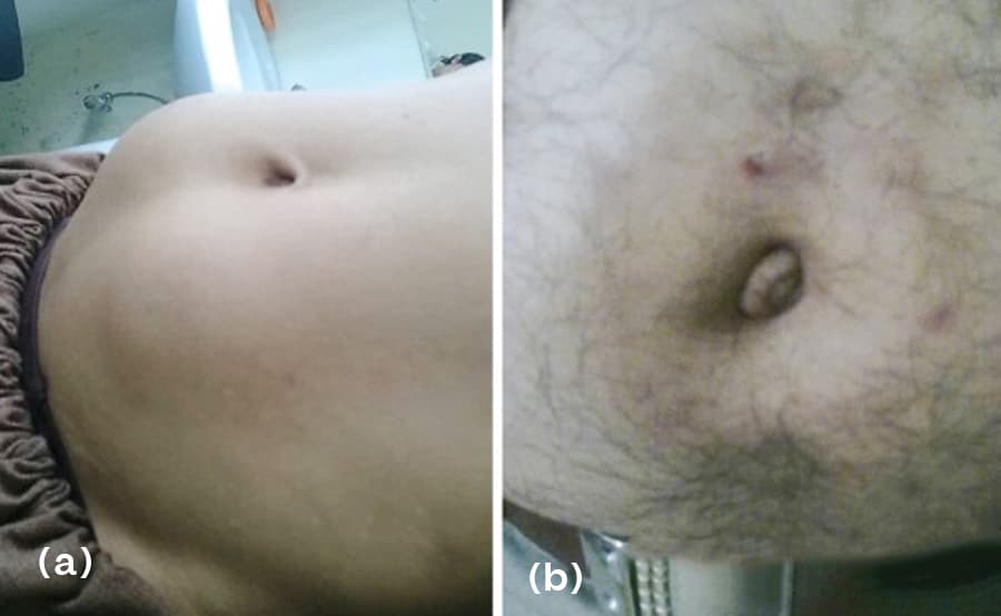 What are the Insulin injection site Complications?