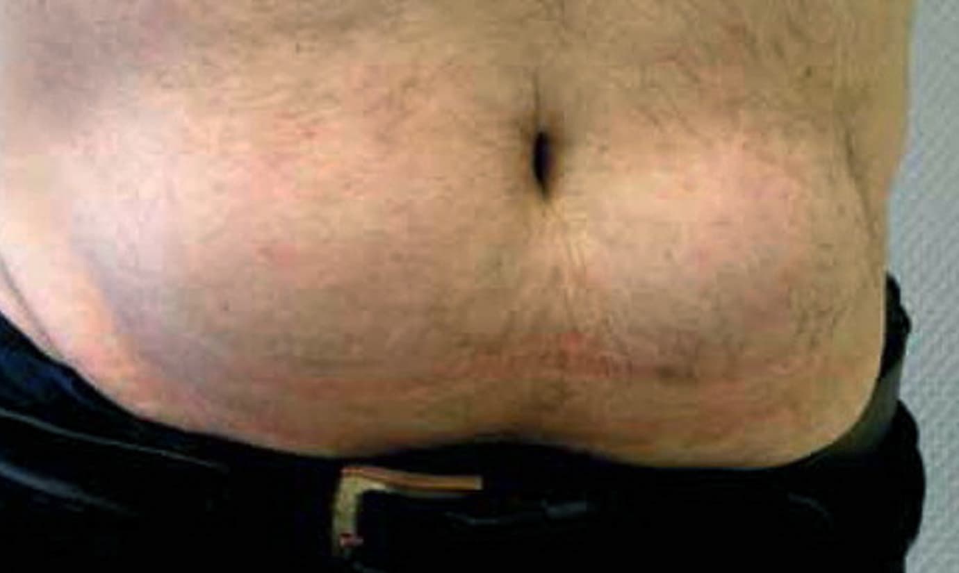 What happens if you Don’t Rotate Insulin Injection sites