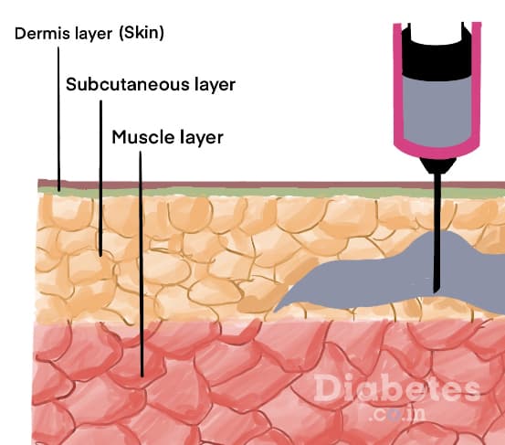 Where do you Inject Insulin?