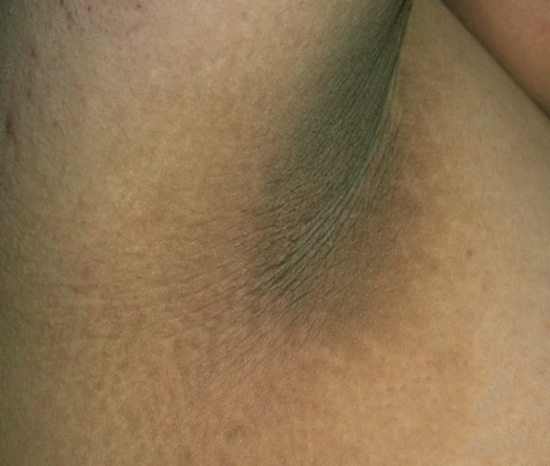 What are the Warning Signs of Prediabetes?