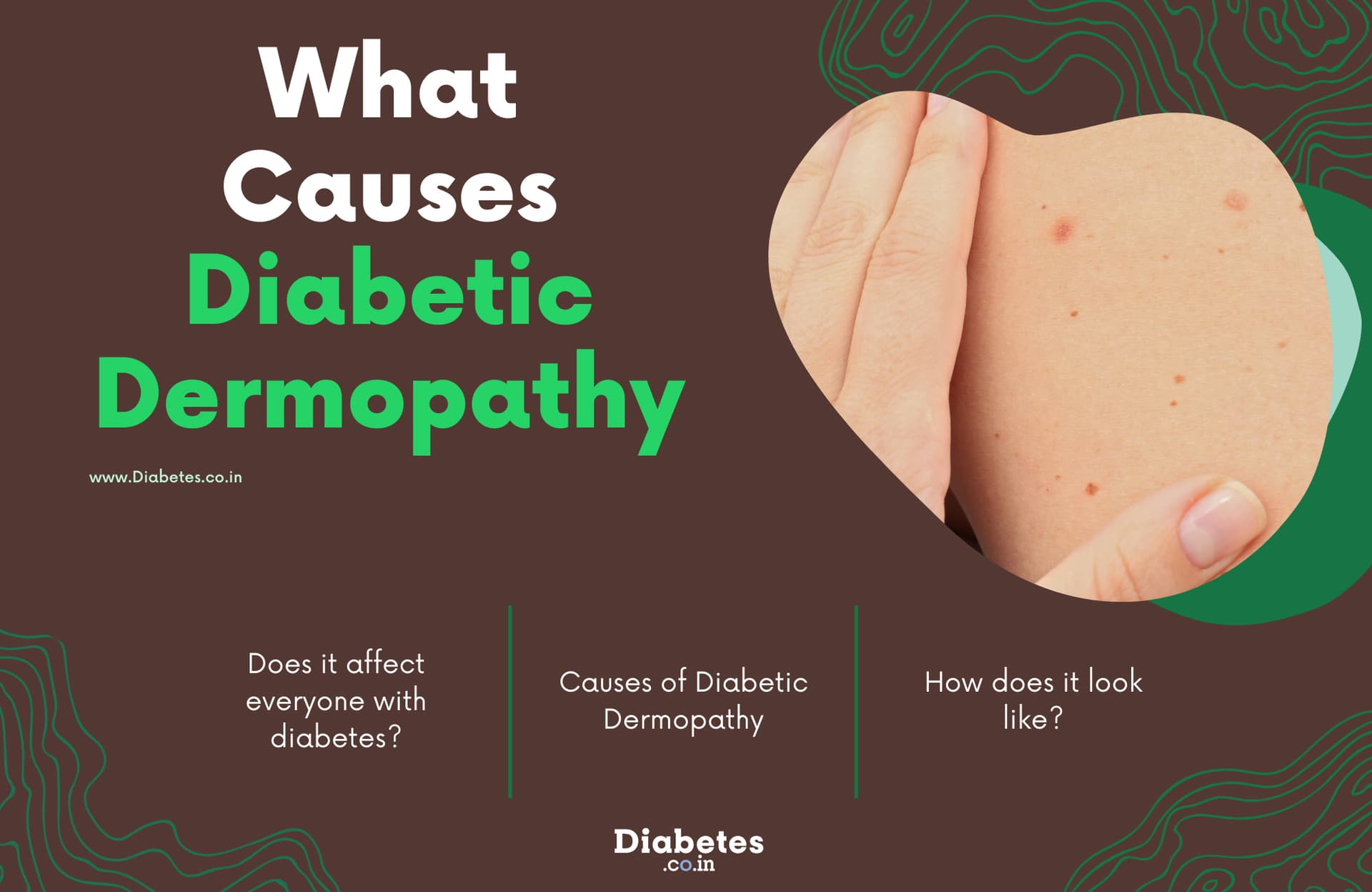 What is Diabetes Dermopathy?