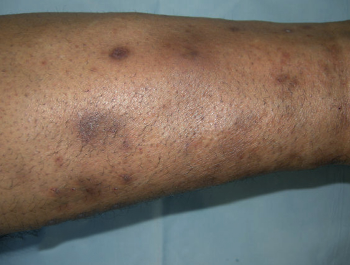 Diabetic Spots On Skin