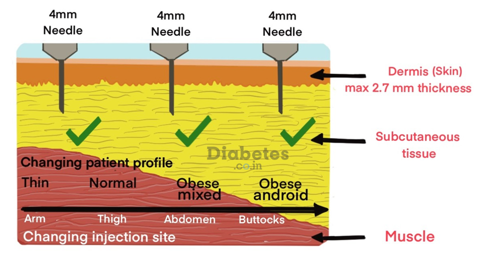 subcutaneous injection insulin