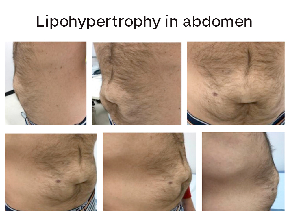 lipohypertrophy in abdomen
