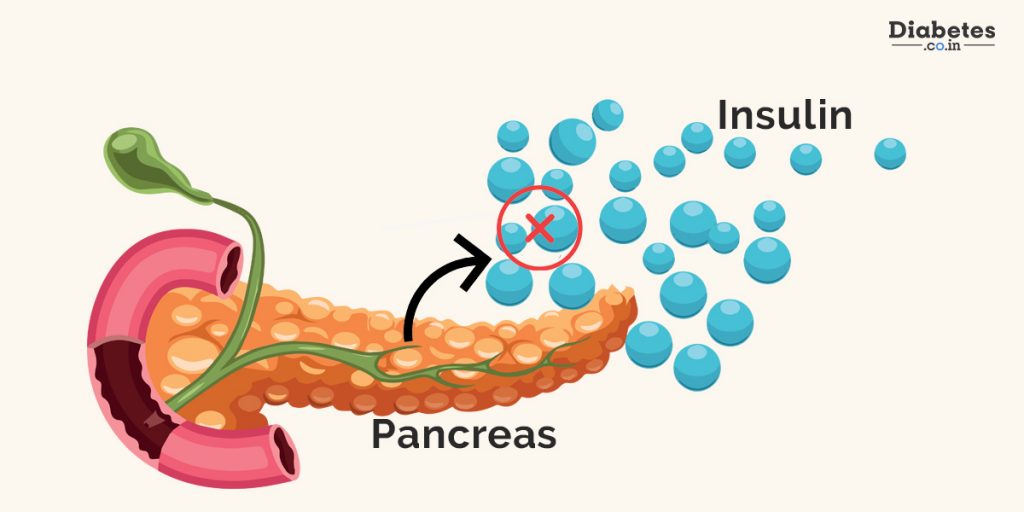 Can Stress cause Diabetes?