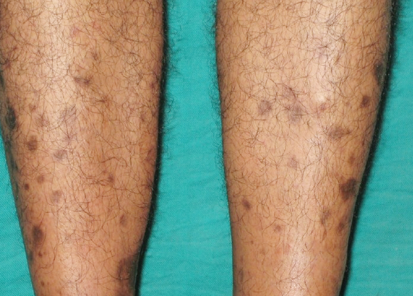 Dermopathy On Legs