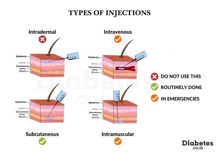 Insulin Injection Sites Diagram Printable - prntbl ...